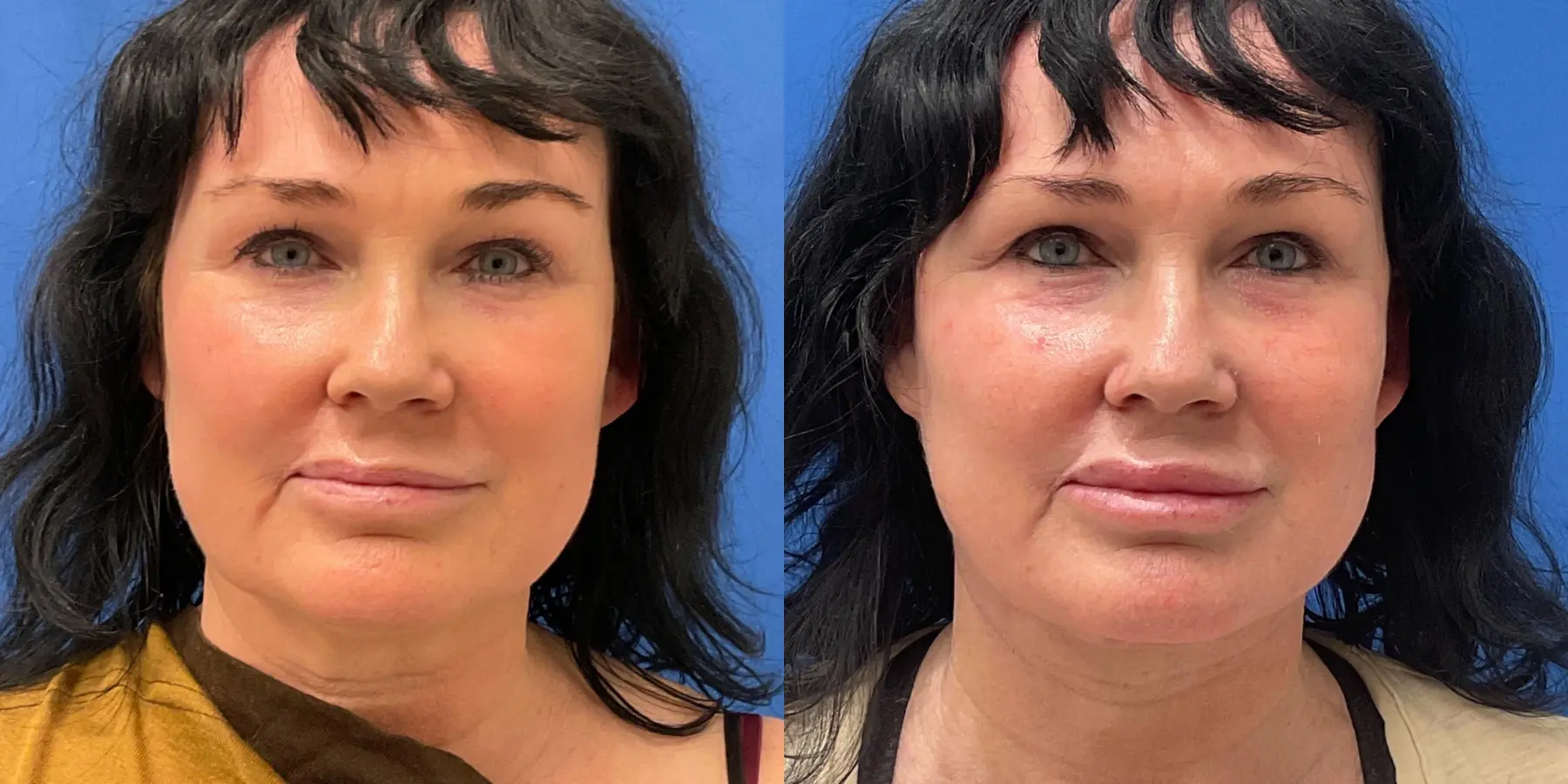 Facelift: Patient 5 - Before and After 3