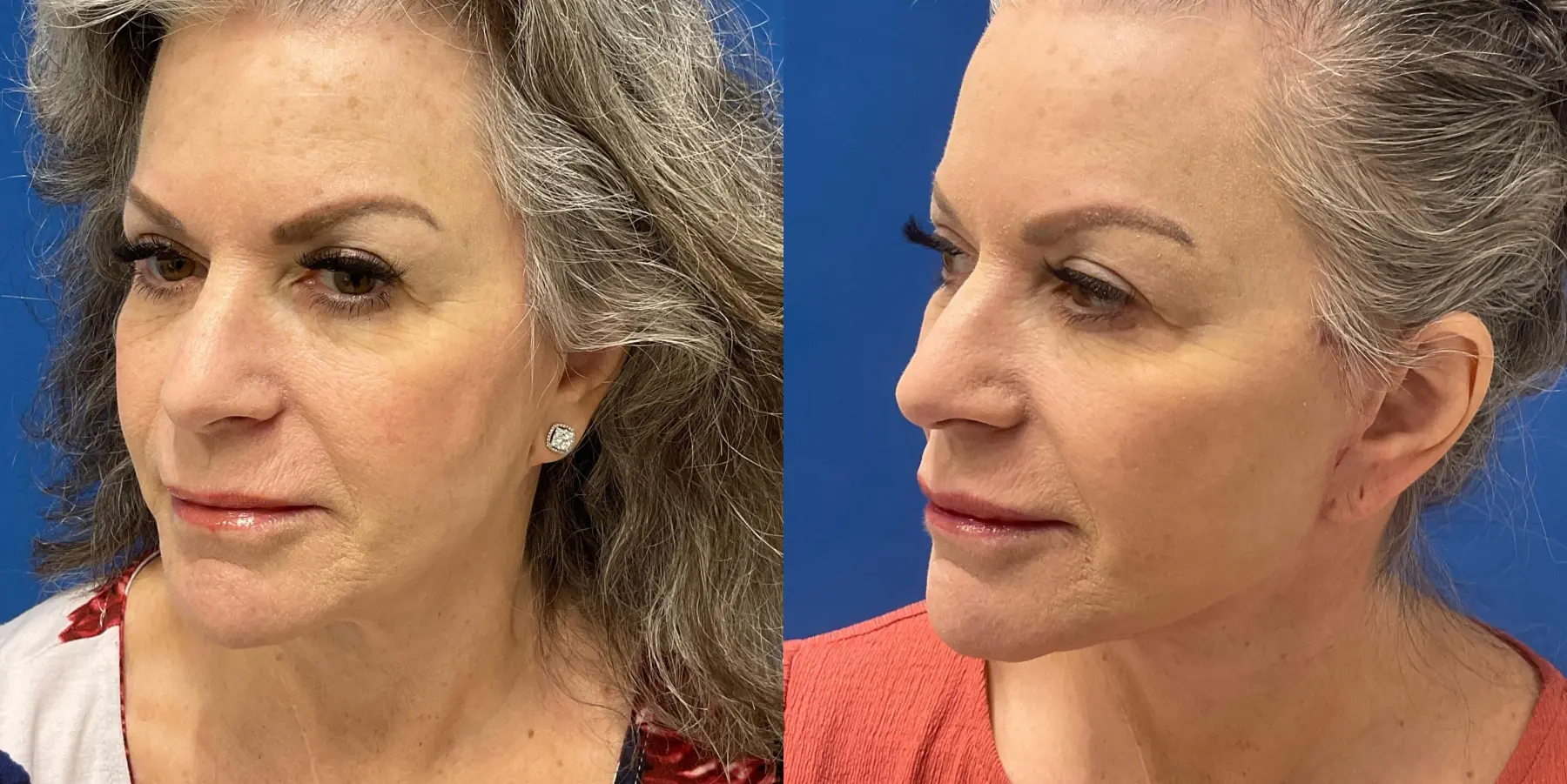 Facelift: Patient 6 - Before and After 4