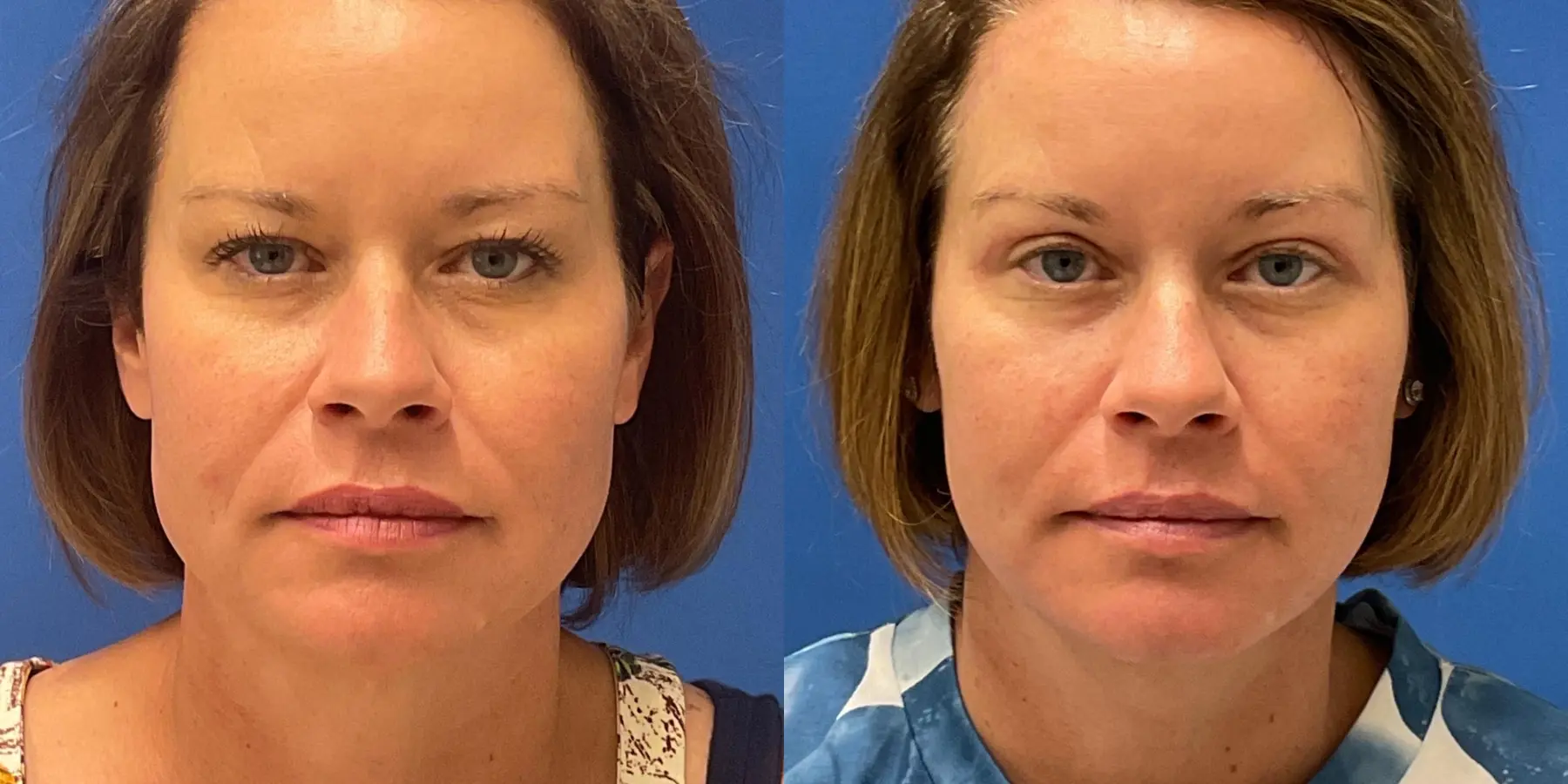 Before and after images of a Facelift. - Before and After 3