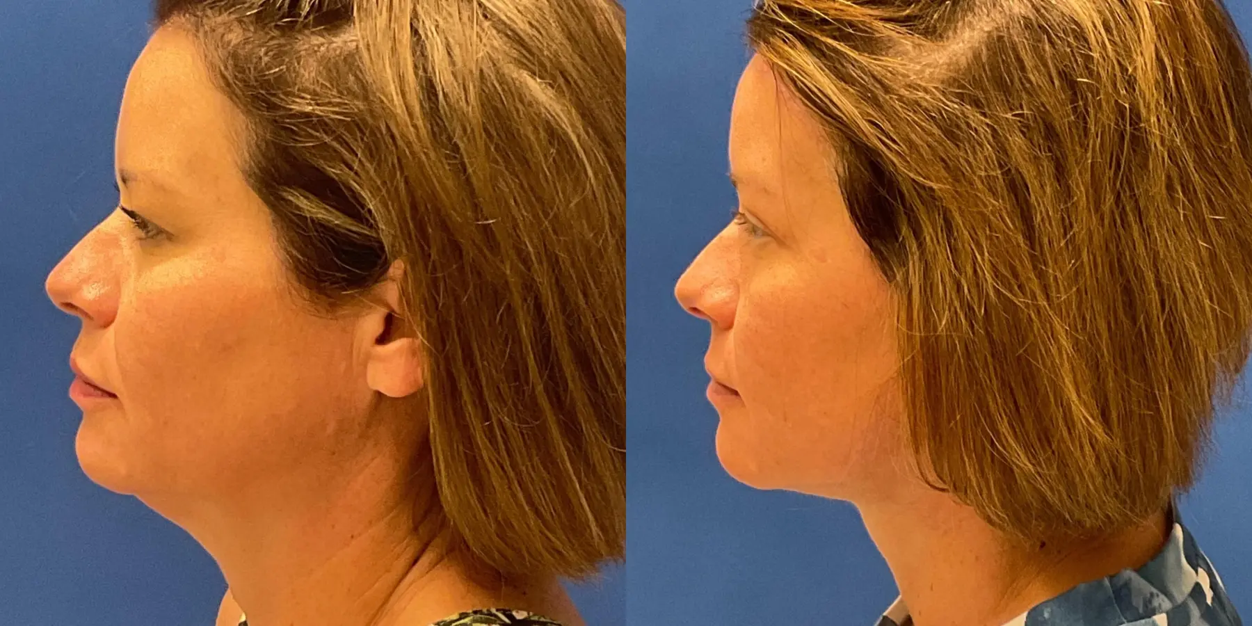 Before and after images of a Facelift. - Before and After 5