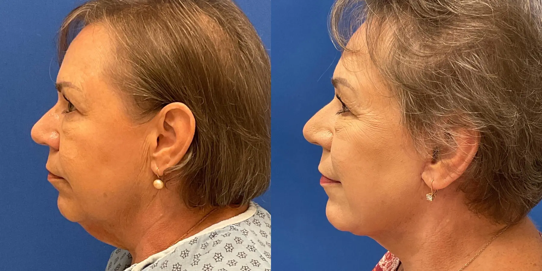 Before and after images of a Facelift. - Before and After 4