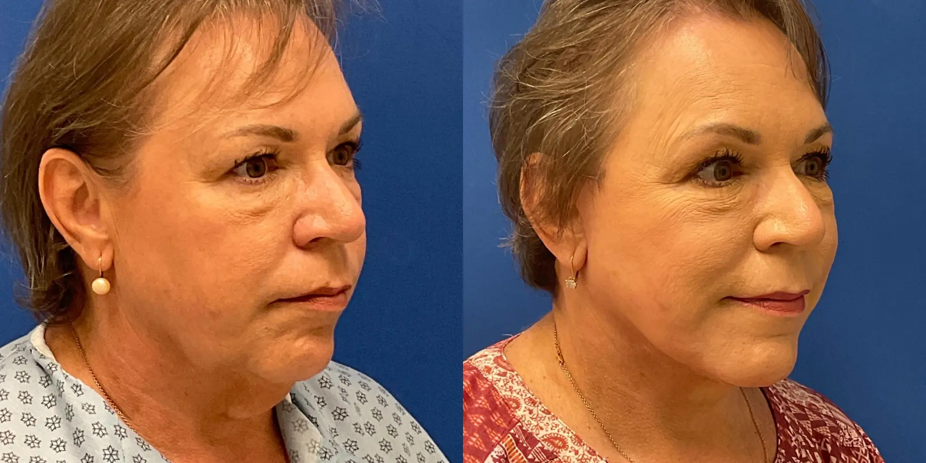 Before and after images of a Facelift. - Before and After 2