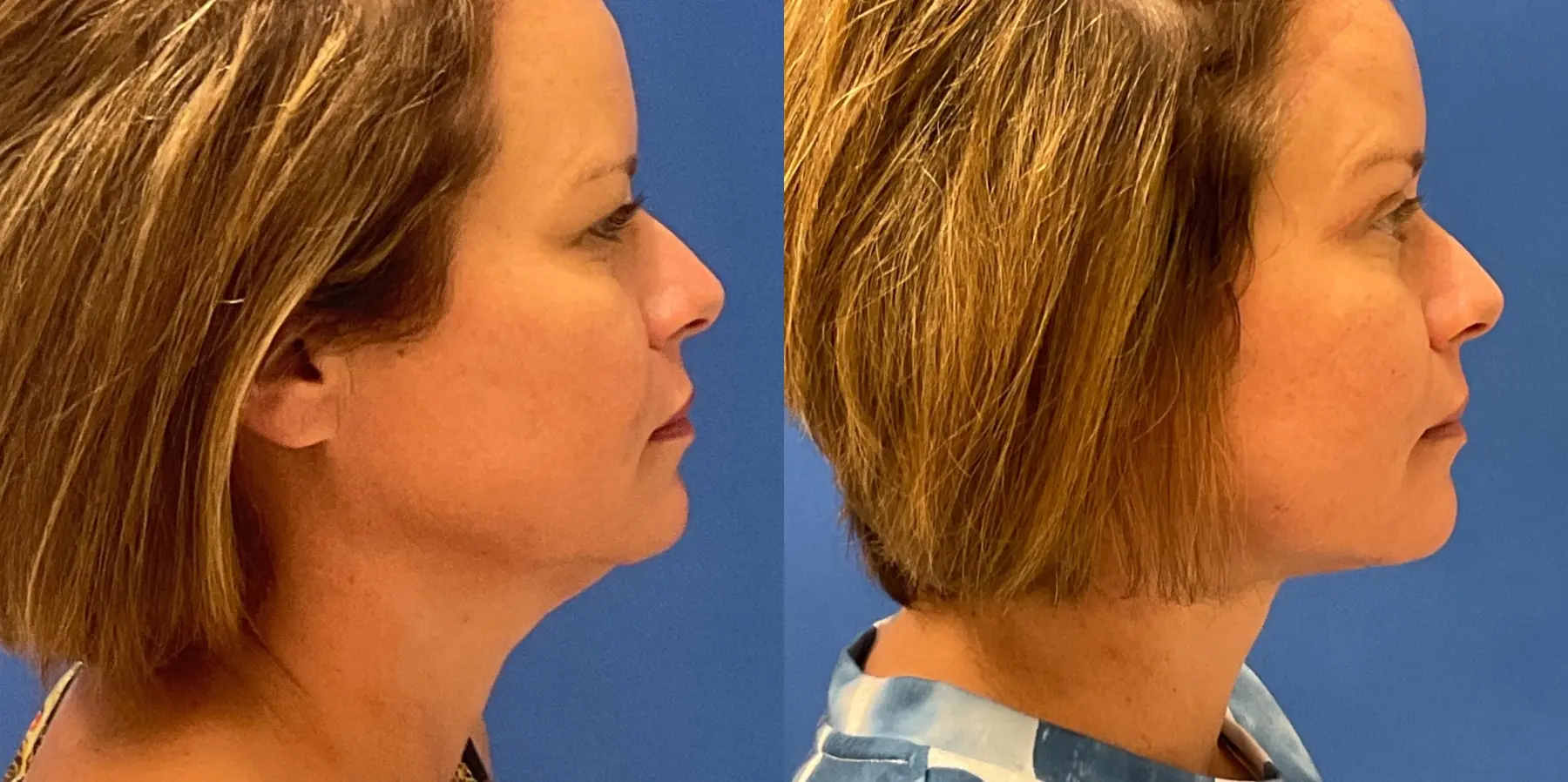 Before and after images of a Facelift. - Before and After 1