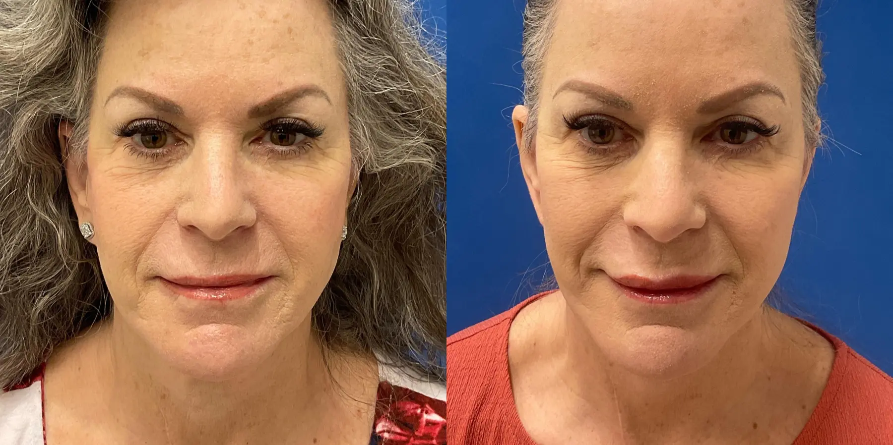 Facelift: Patient 6 - Before and After 3