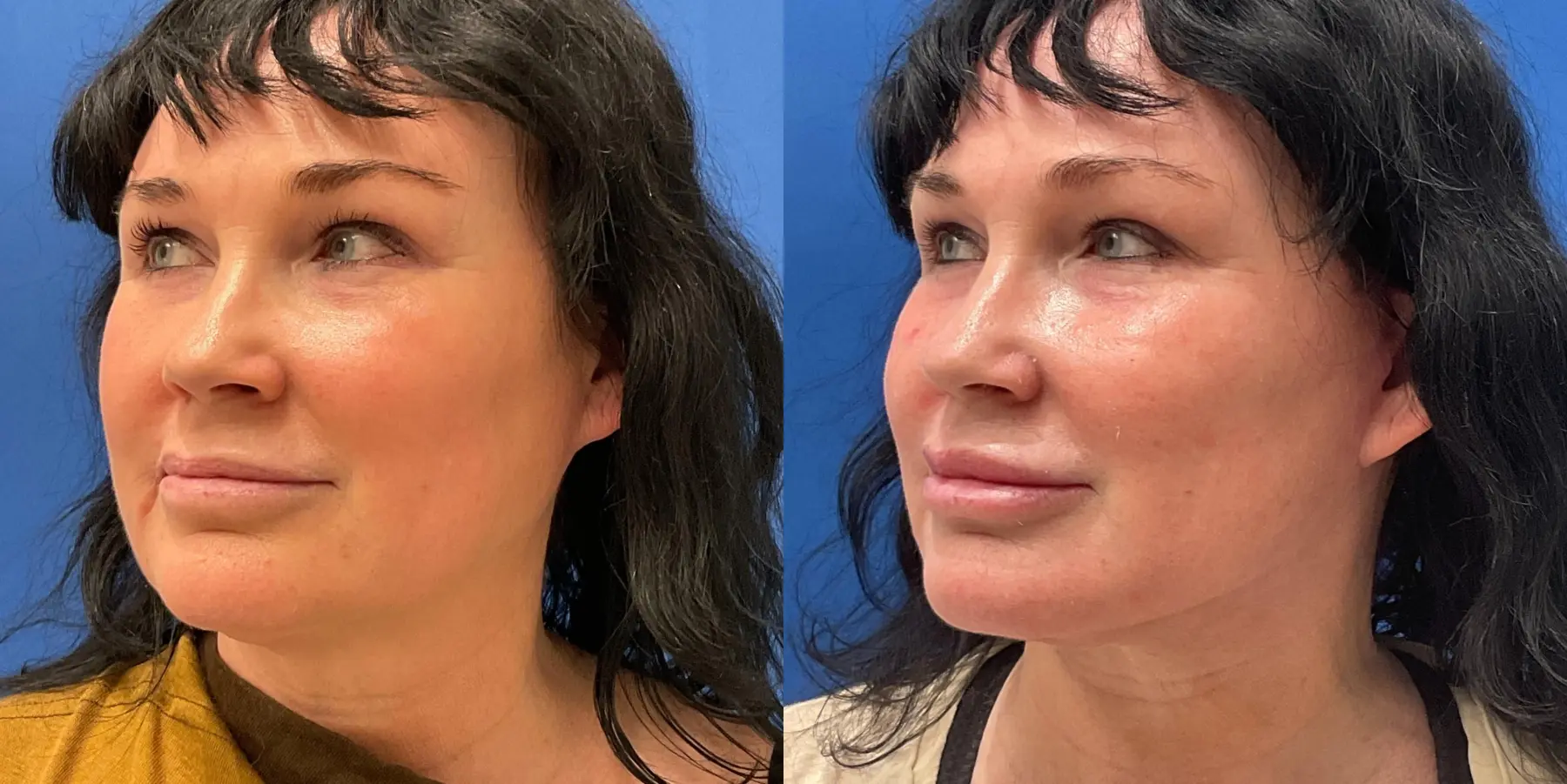 Facelift: Patient 5 - Before and After 4