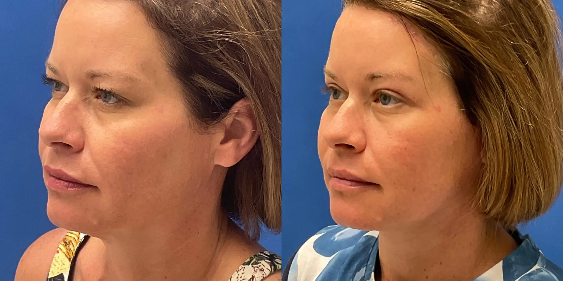 Before and after images of a Facelift. - Before and After 4