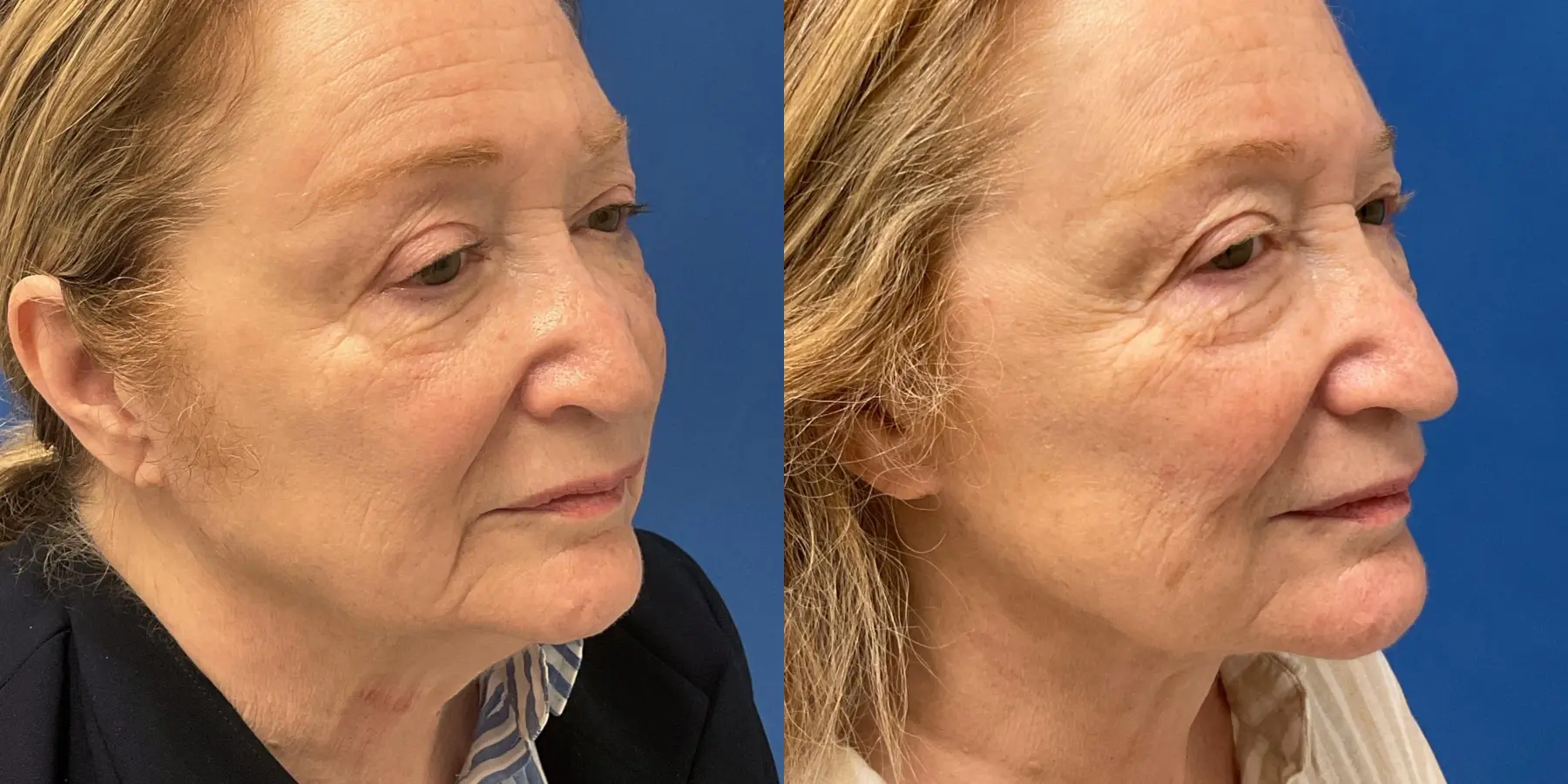 Before and after images of a Facelift. - Before and After 2