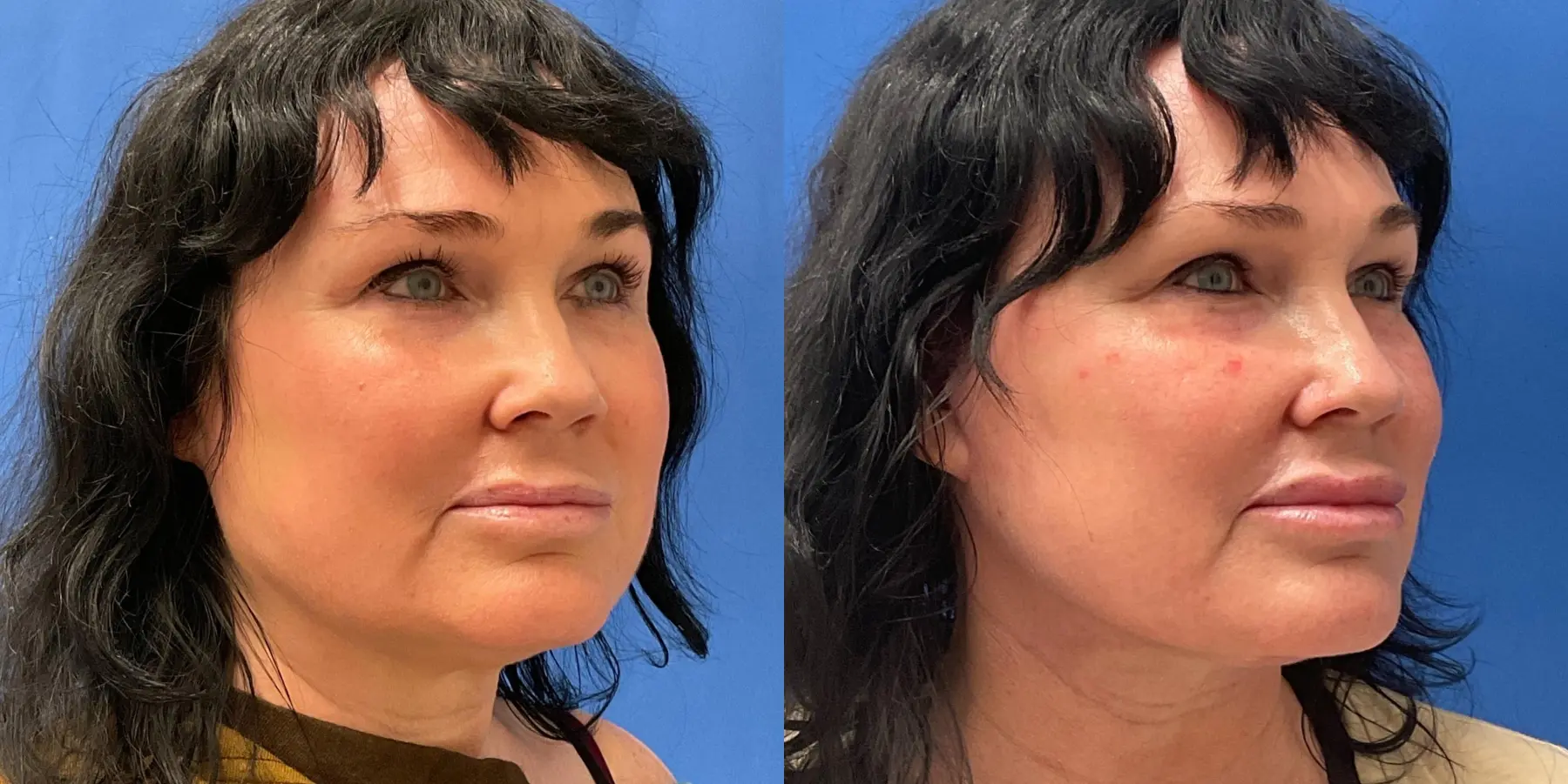 Facelift: Patient 5 - Before and After 2