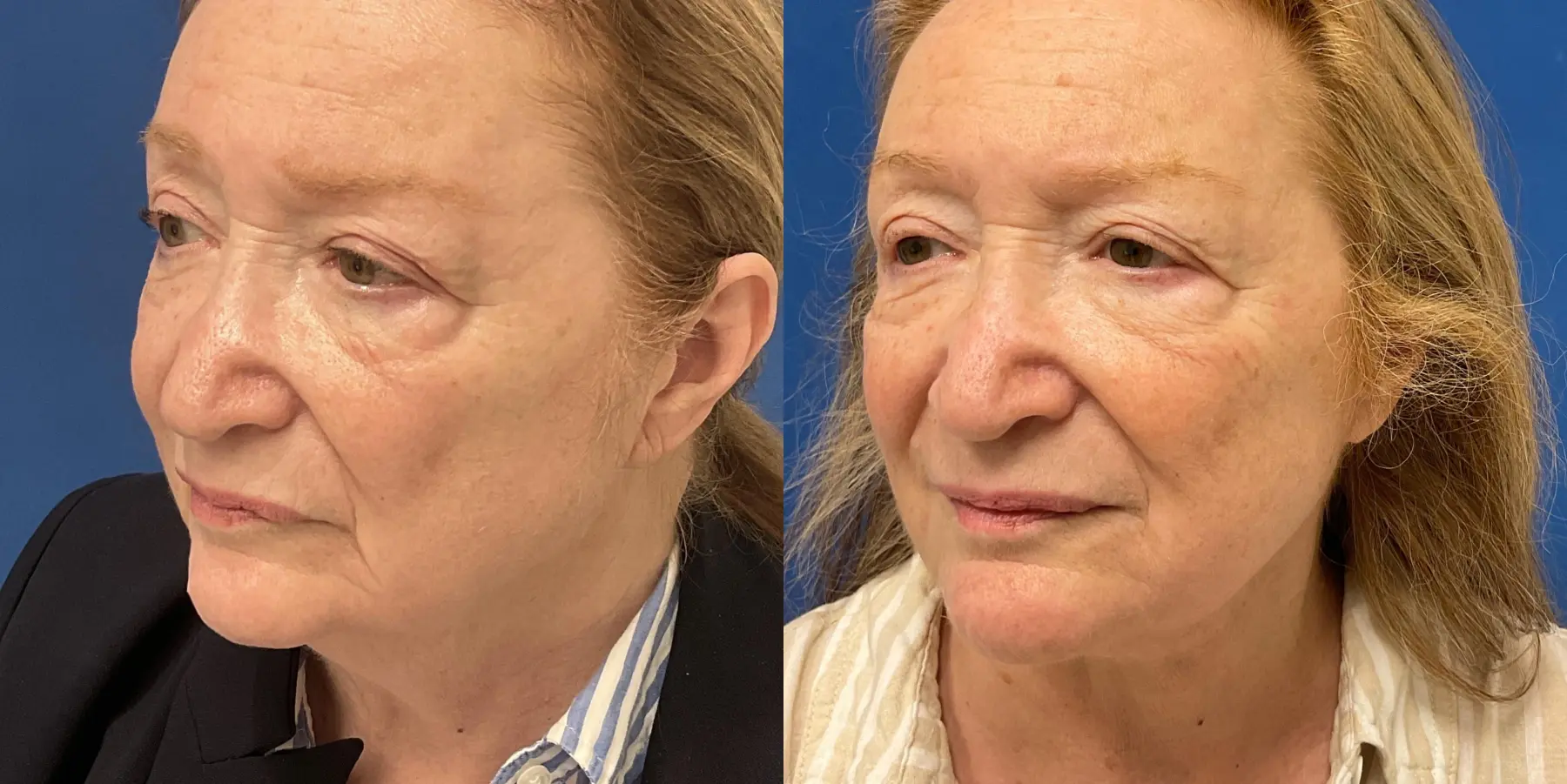 Before and after images of a Facelift. - Before and After 4