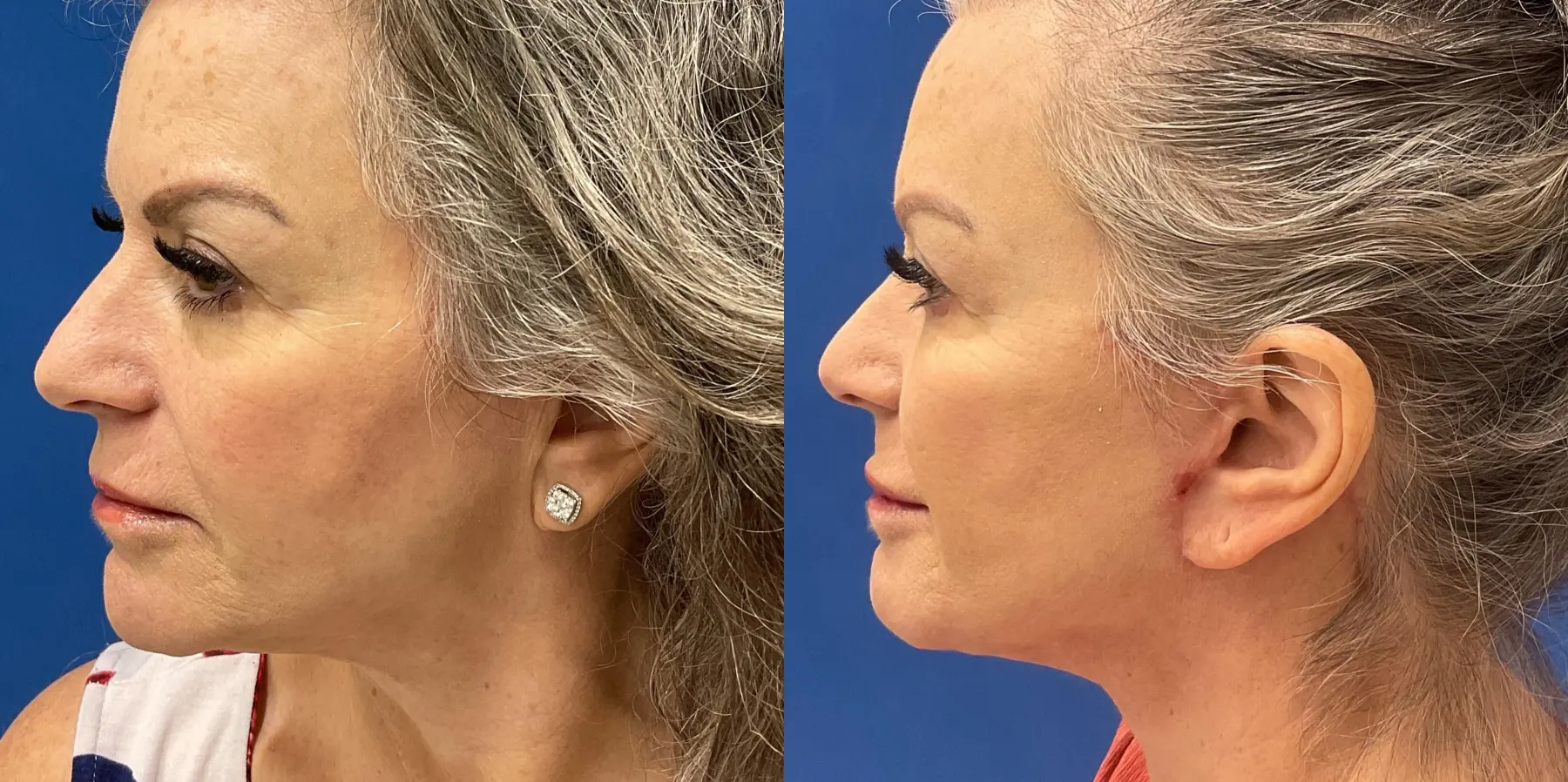 Facelift: Patient 6 - Before and After 5