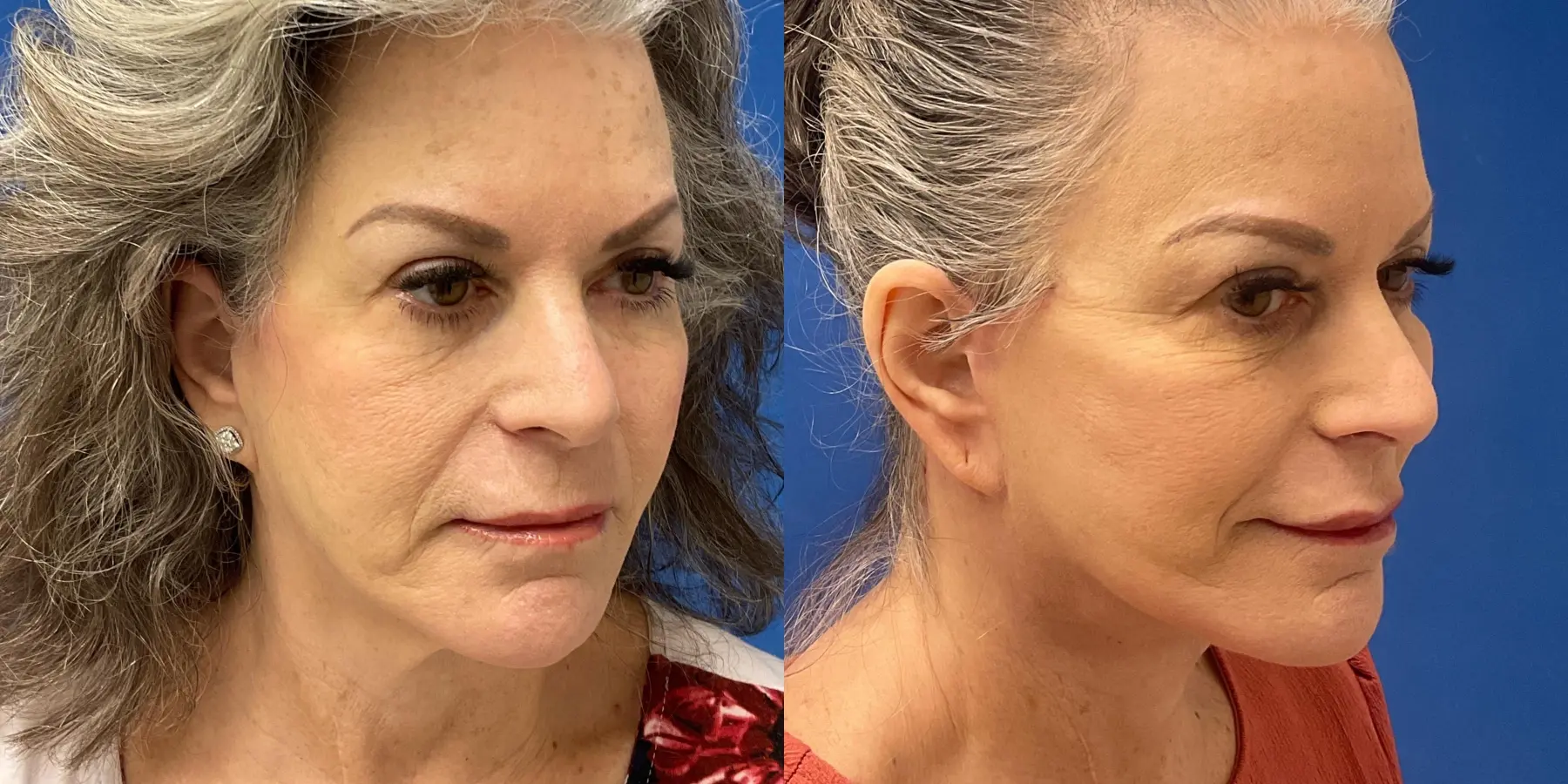 Facelift: Patient 6 - Before and After 2