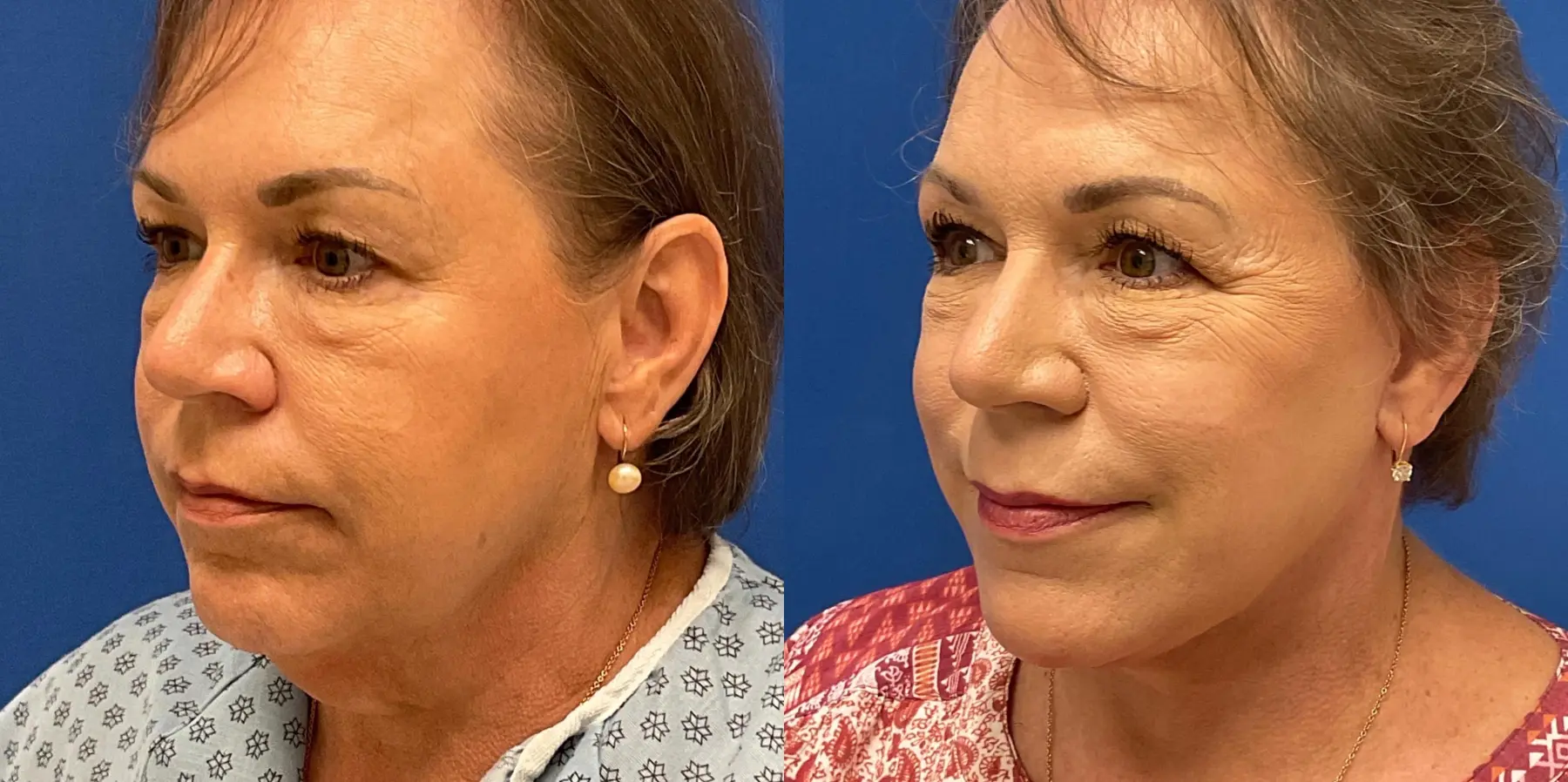 Before and after images of a Facelift. - Before and After 3