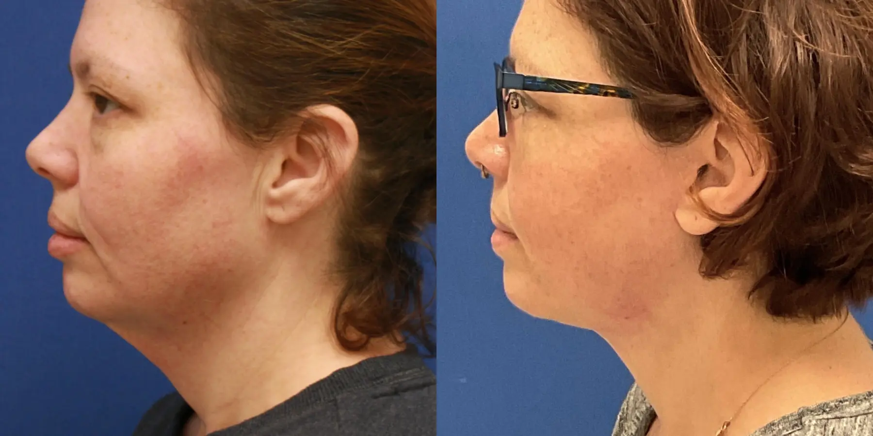 Before and after images of a Facelift. - Before and After 2