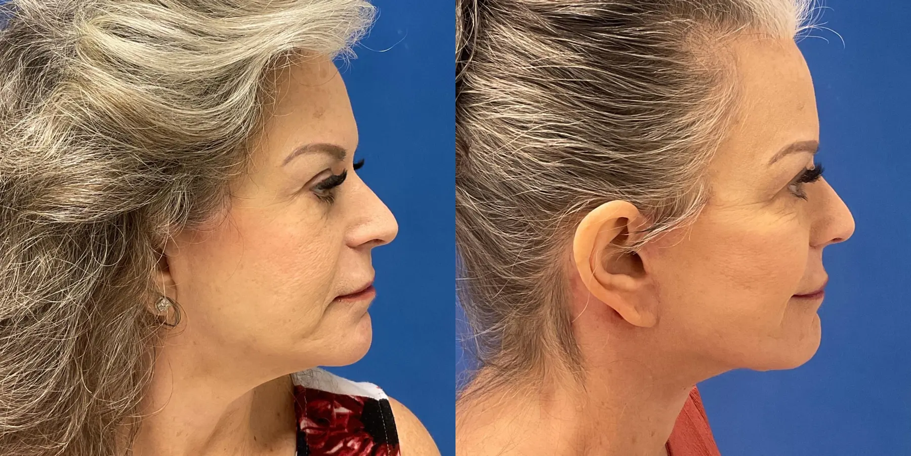 Facelift: Patient 6 - Before and After 1