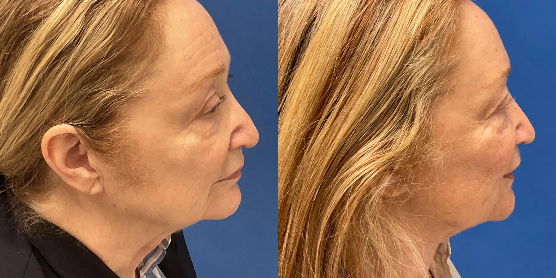 Before and after images of a Facelift. - Before and After