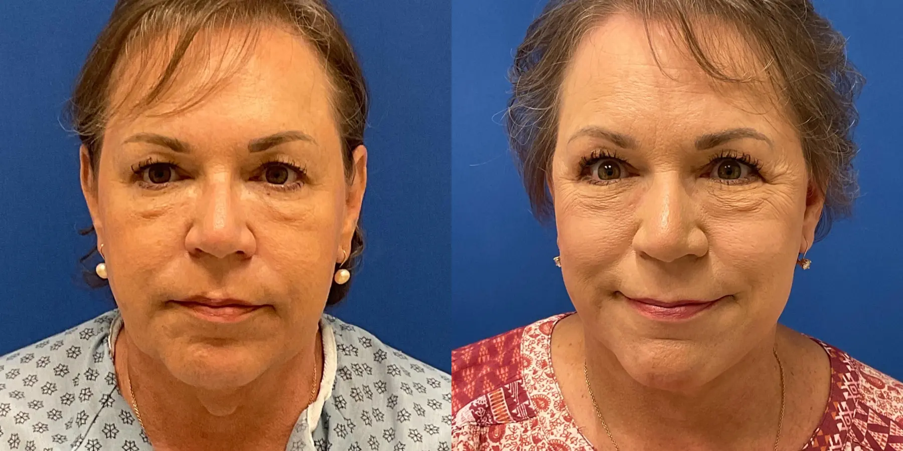 Before and after images of a Facelift. - Before and After 5