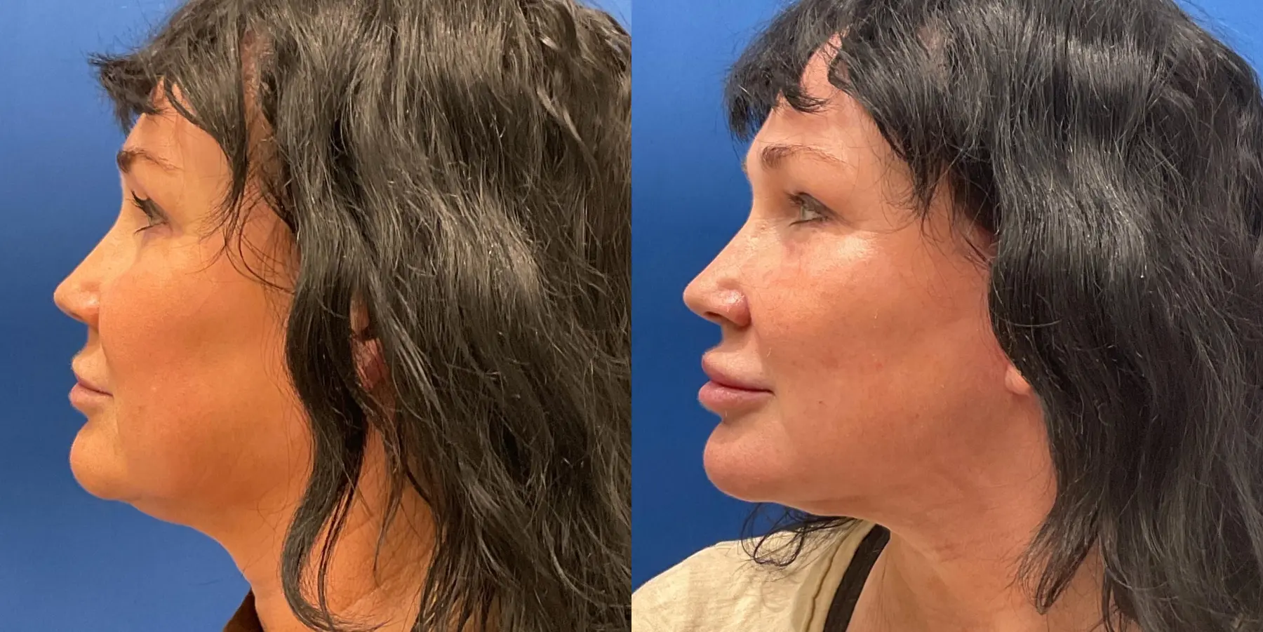 Facelift: Patient 5 - Before and After 5