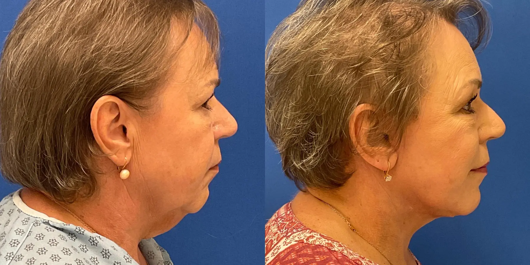 Before and after images of a Facelift. - Before and After 1