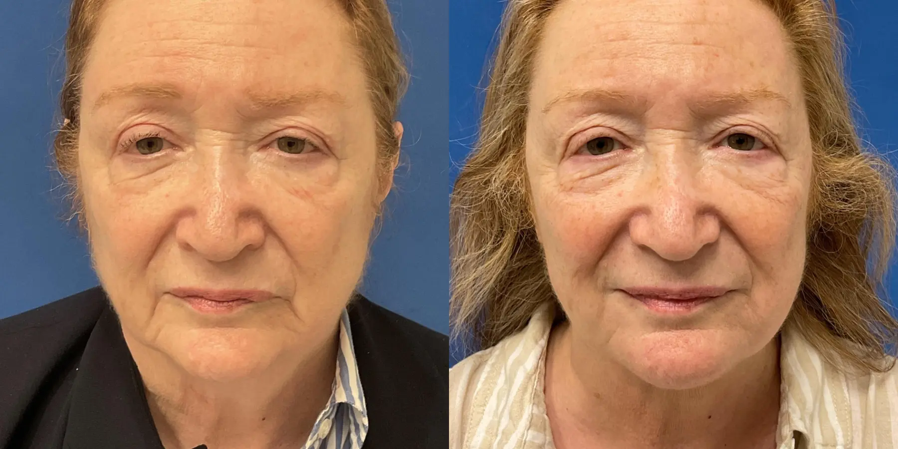 Before and after images of a Facelift. - Before and After 3