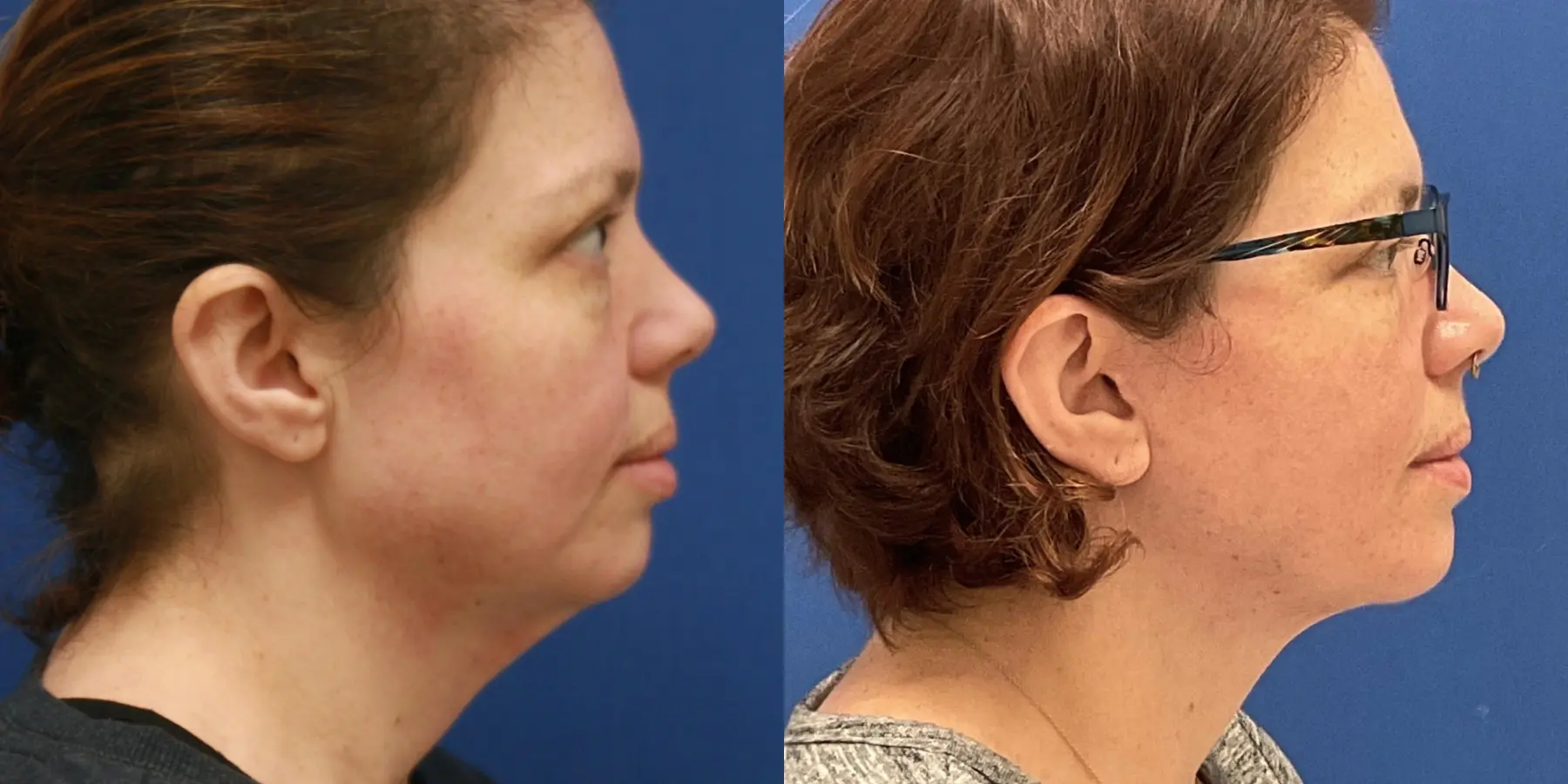 Before and after images of a Facelift. - Before and After 1