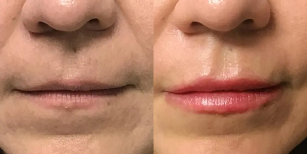 Before and after images of a Filler. - Before and After 1