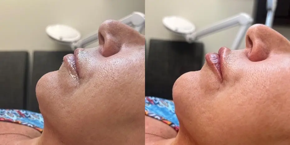 Before and after images of a Filler. - Before and After 1