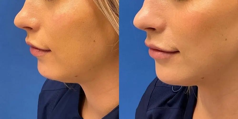 Before and after images of a Filler. - Before and After 1