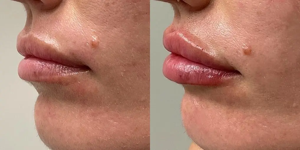 Fillers: Patient 1 - Before and After  