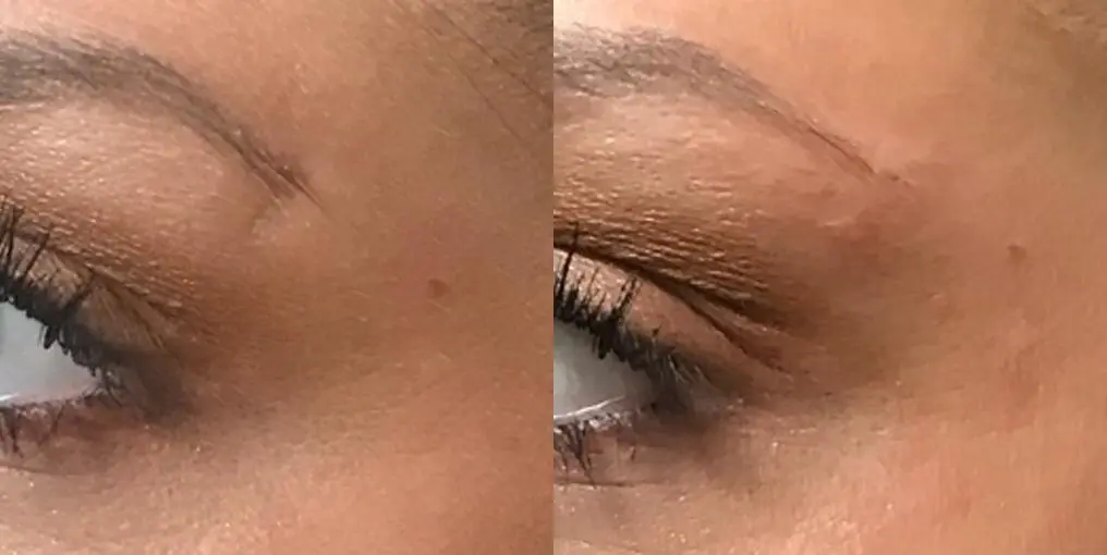 Before and after images of an eye filler. - Before and After