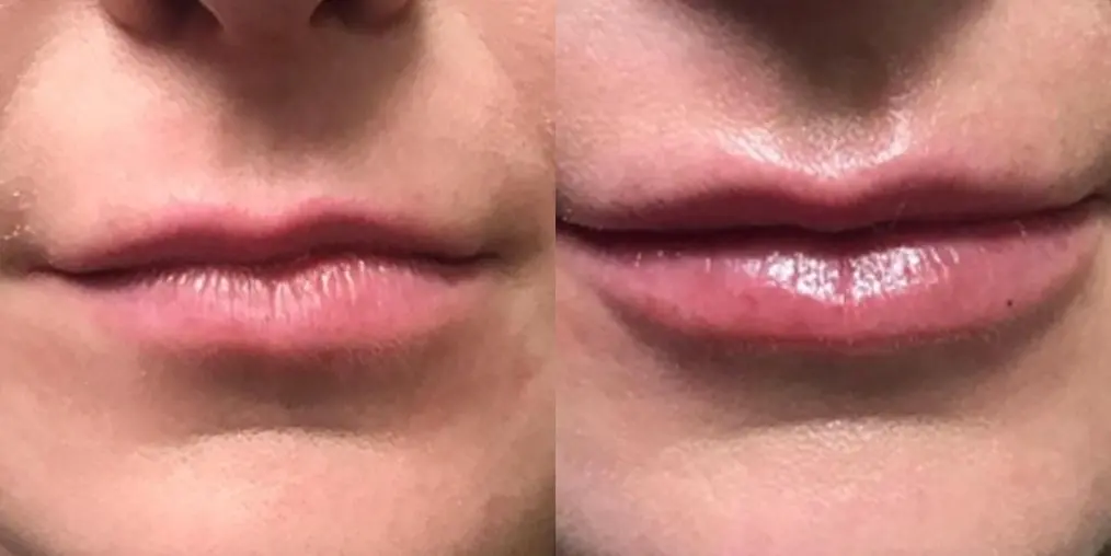 Before and after images of a Filler. - Before and After