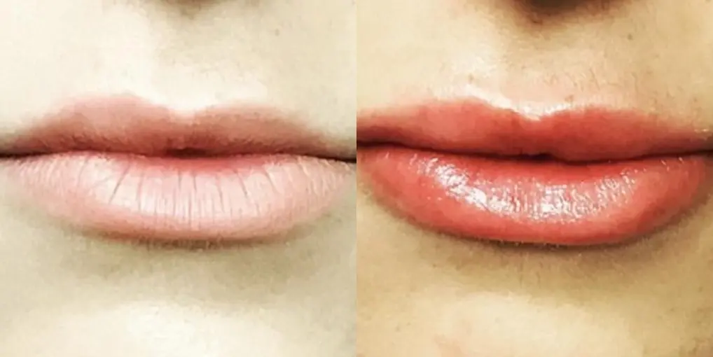 Before and after images of a Filler. - Before and After 1