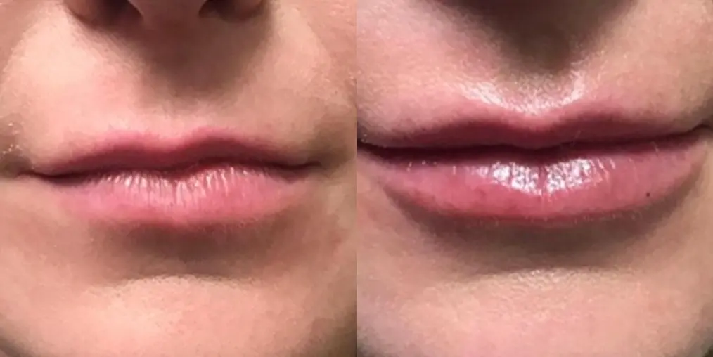 Before and after a lip filler. - Before and After