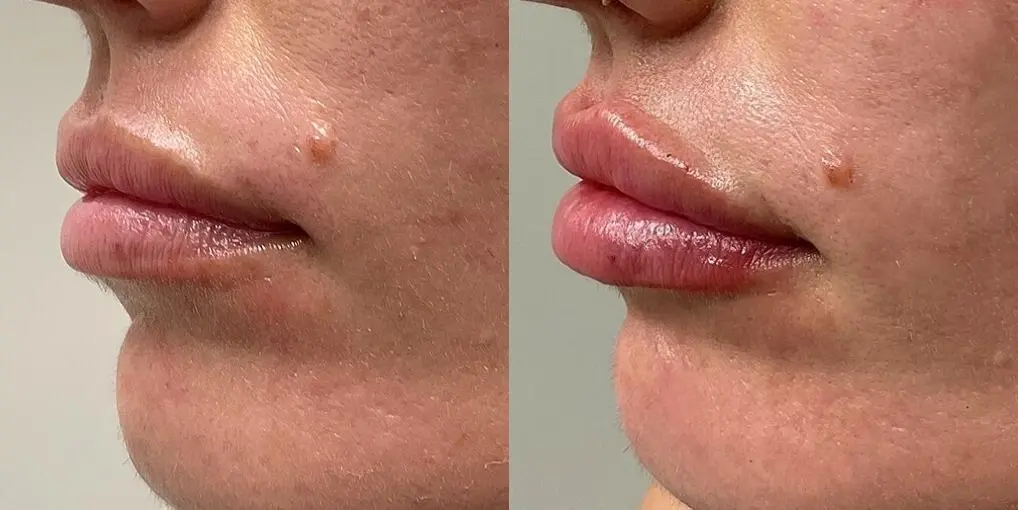 Lip Filler: Patient 1 - Before and After  