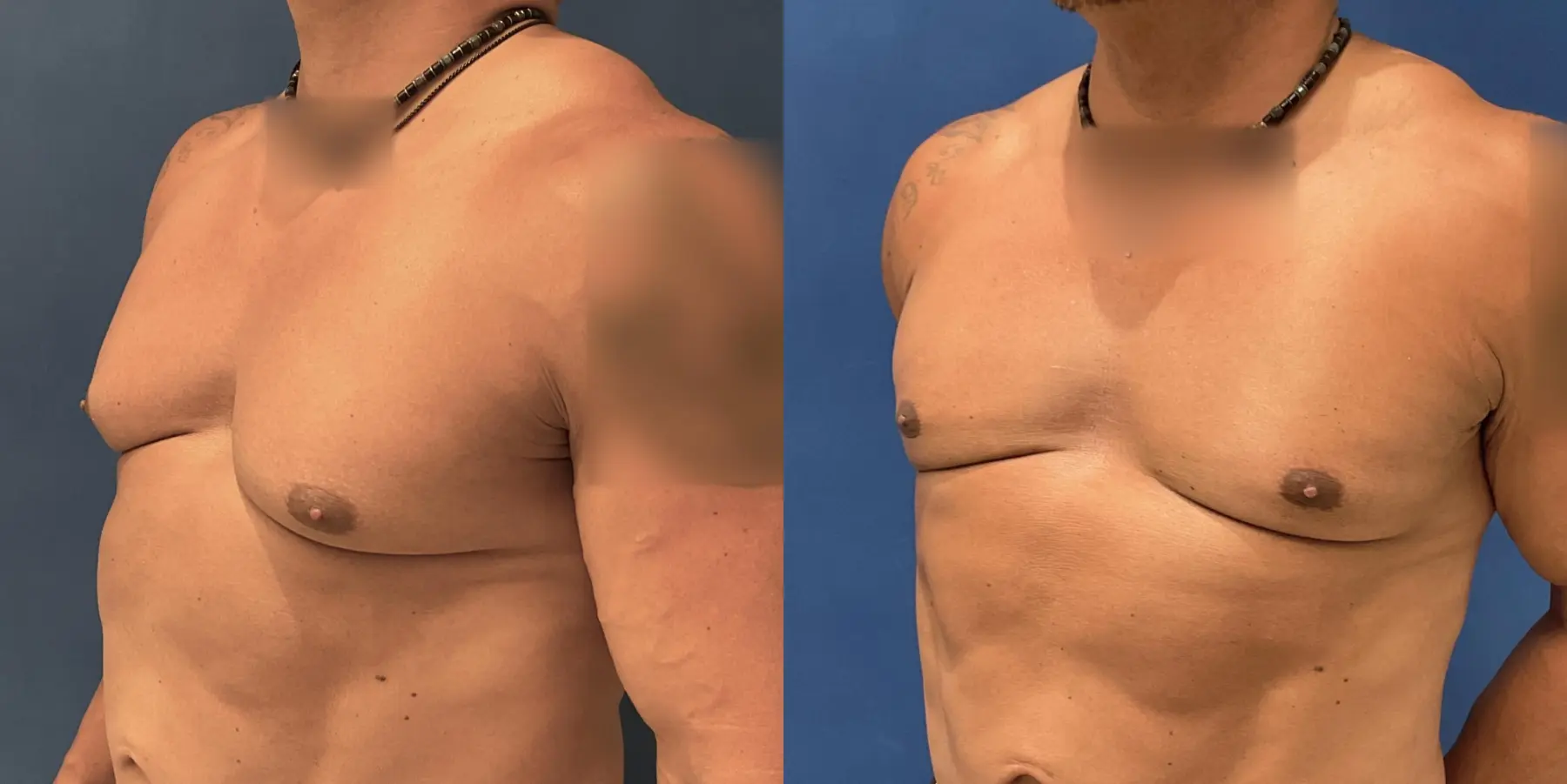 Liposuction For Men: Patient 2 - Before and After 2