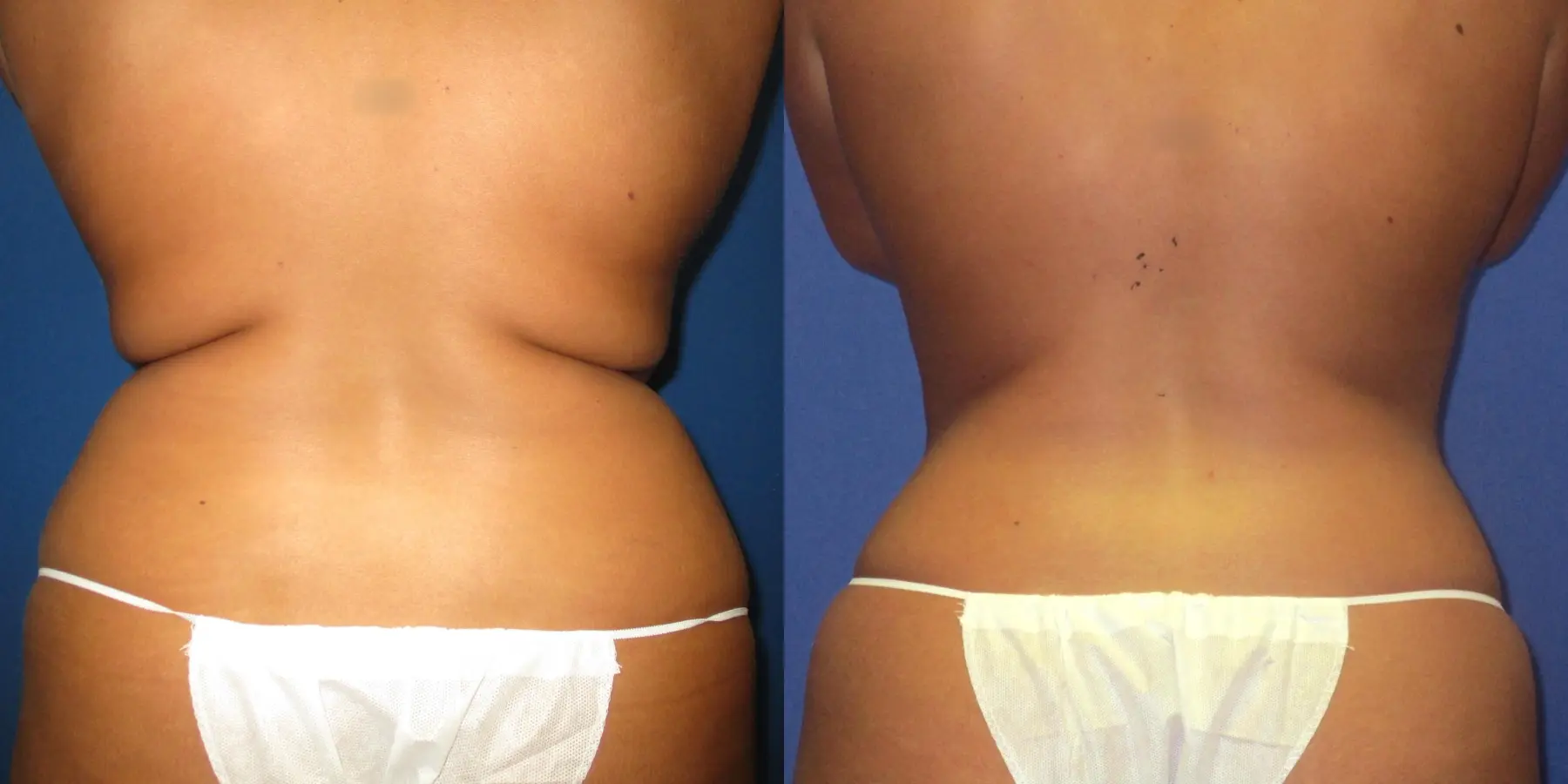 Liposuction: Patient 8 - Before and After 4