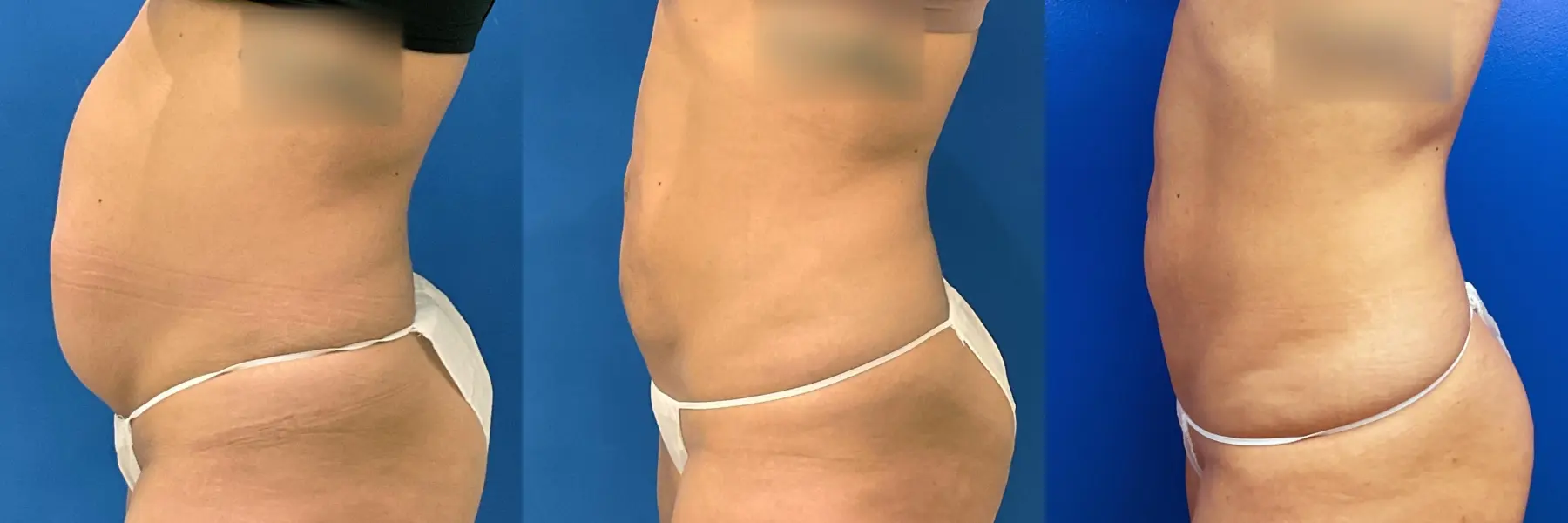 Liposuction: Patient 9 - Before and After 4