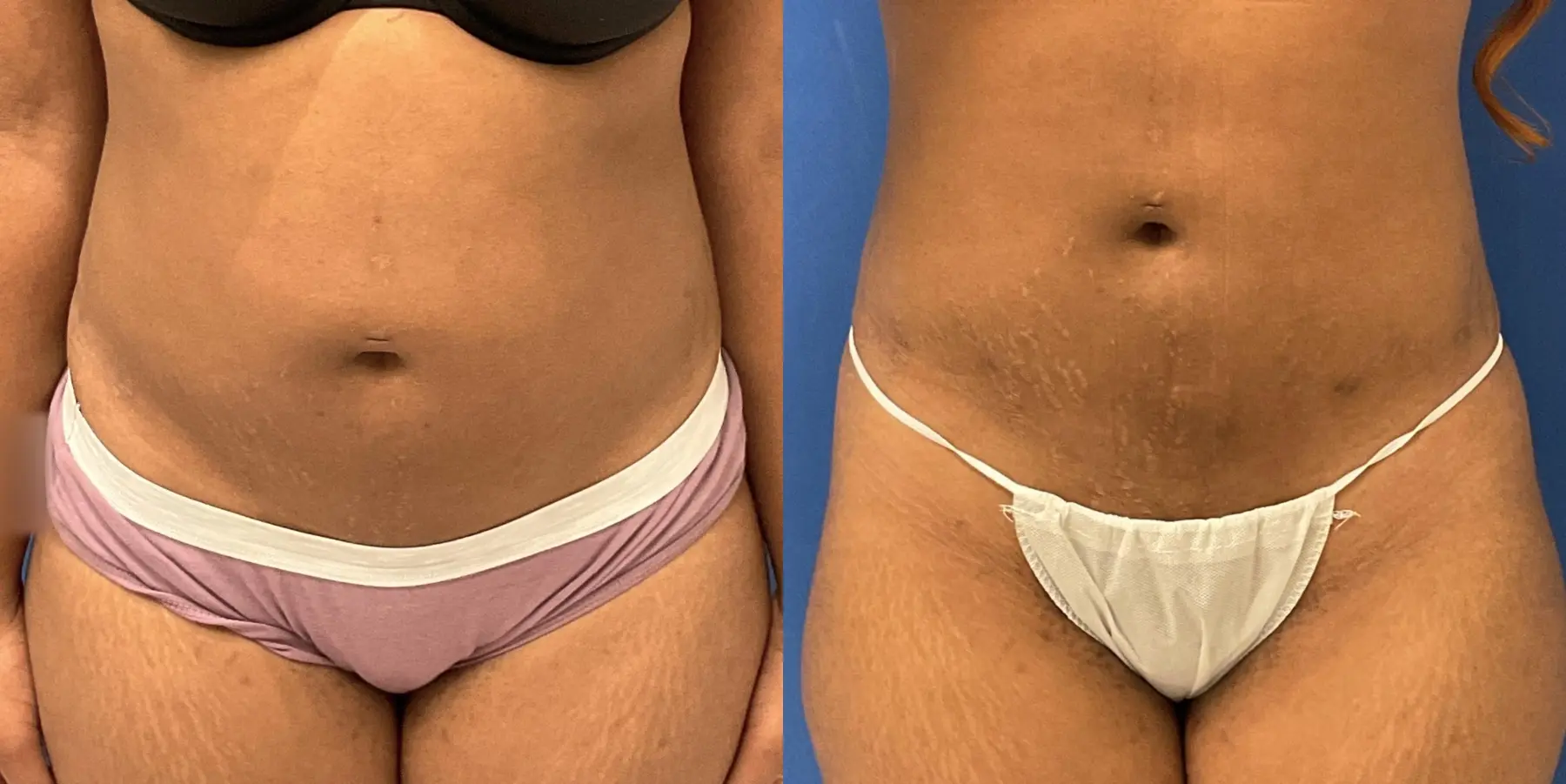 Liposuction: Patient 19 - Before and After 1