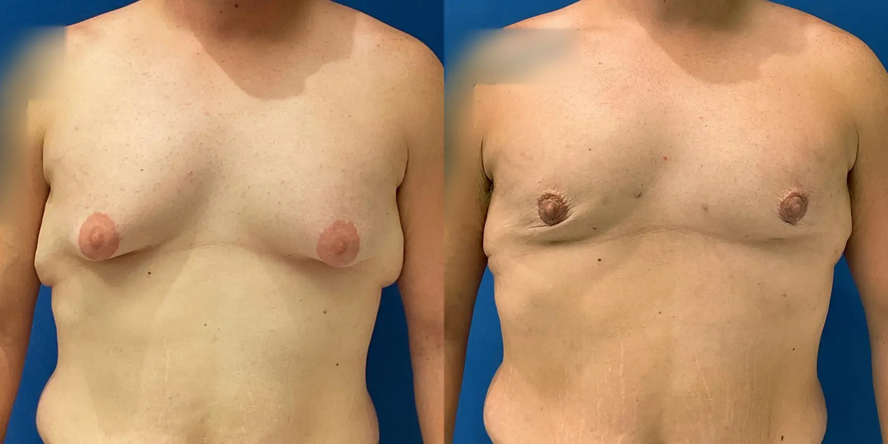 Liposuction-for-men: Patient 7 - Before and After  