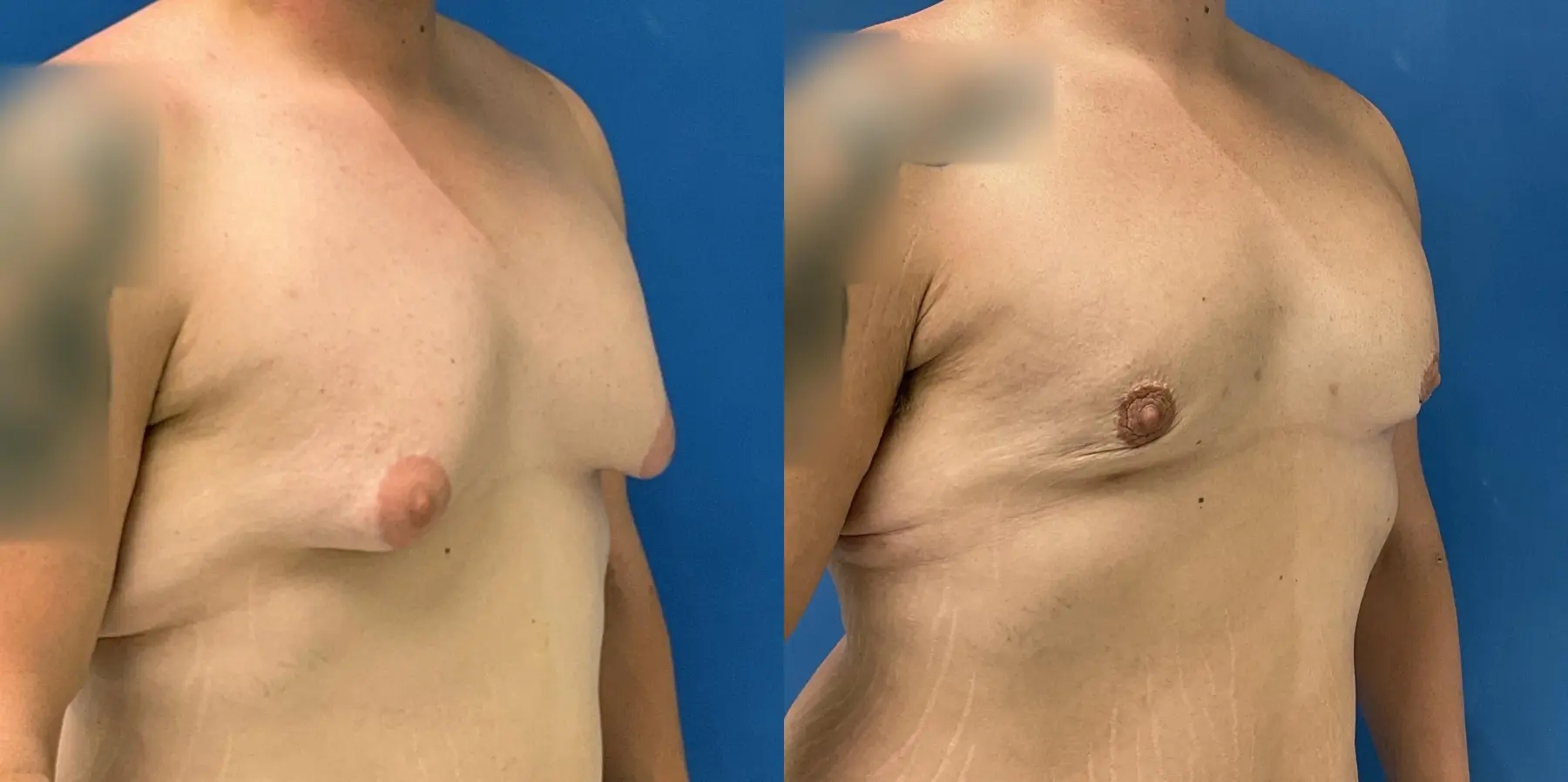 Liposuction For Men: Patient 7 - Before and After 3