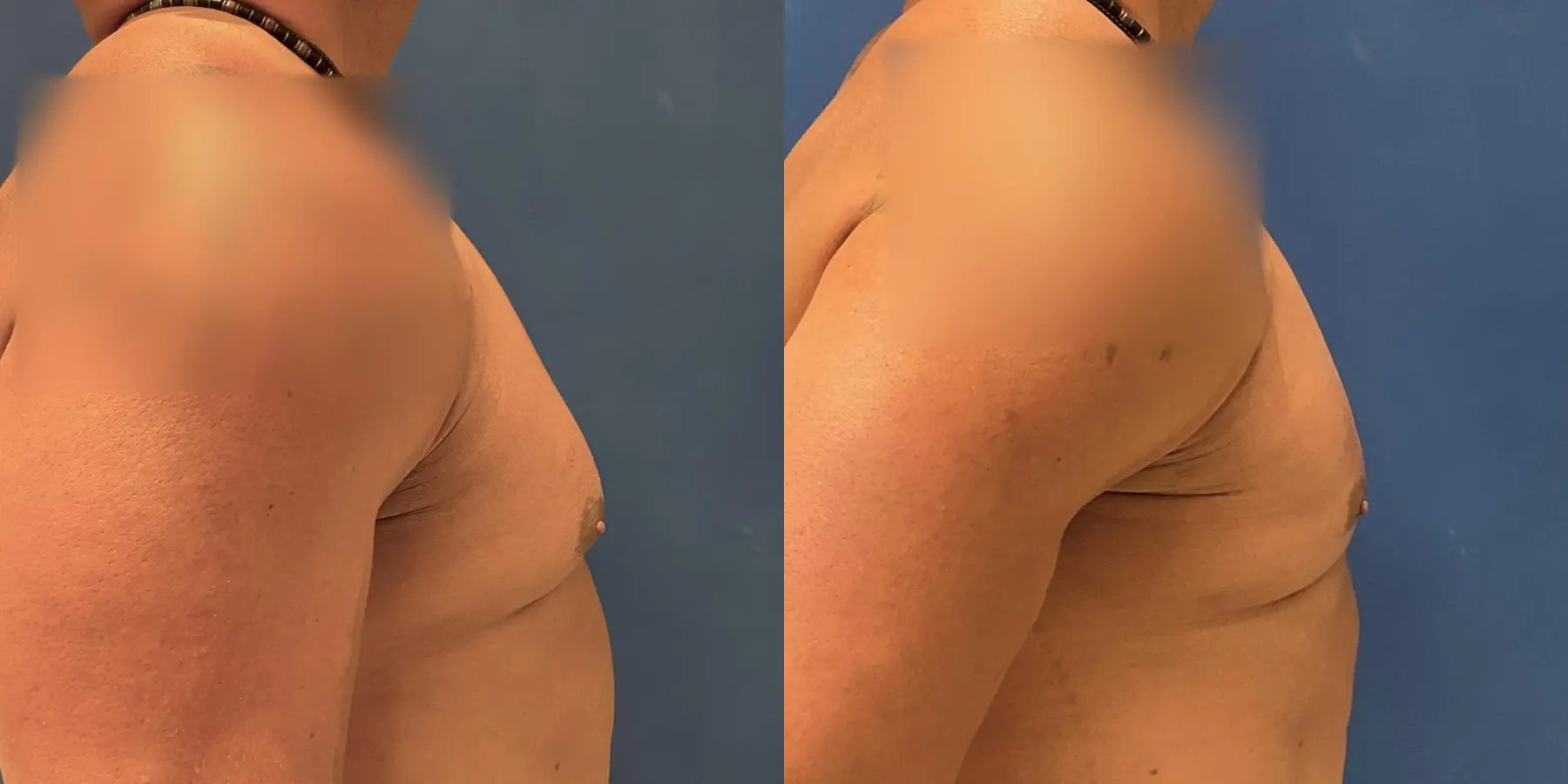 Liposuction For Men: Patient 2 - Before and After 5