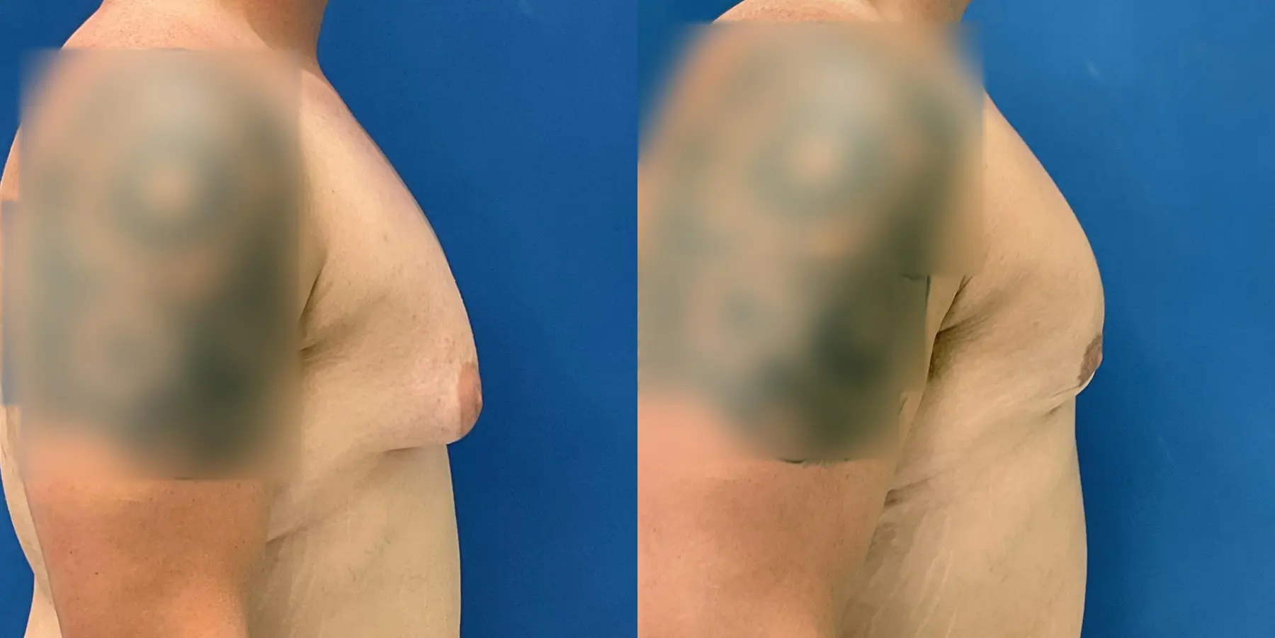 Liposuction For Men: Patient 7 - Before and After 5