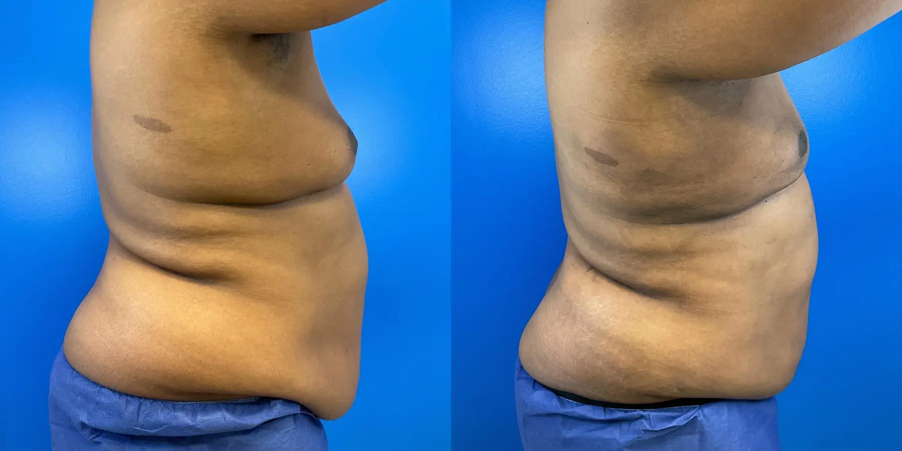 Before and after a liposuction. - Before and After 5