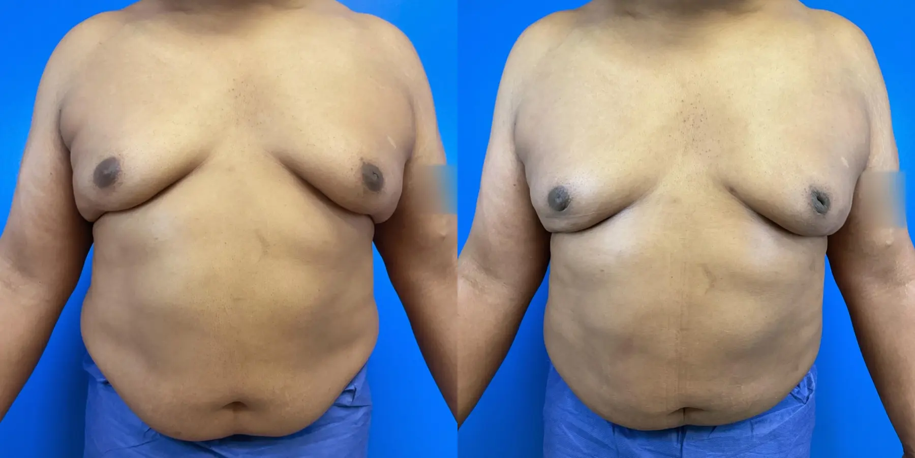 Before and after a liposuction. - Before and After