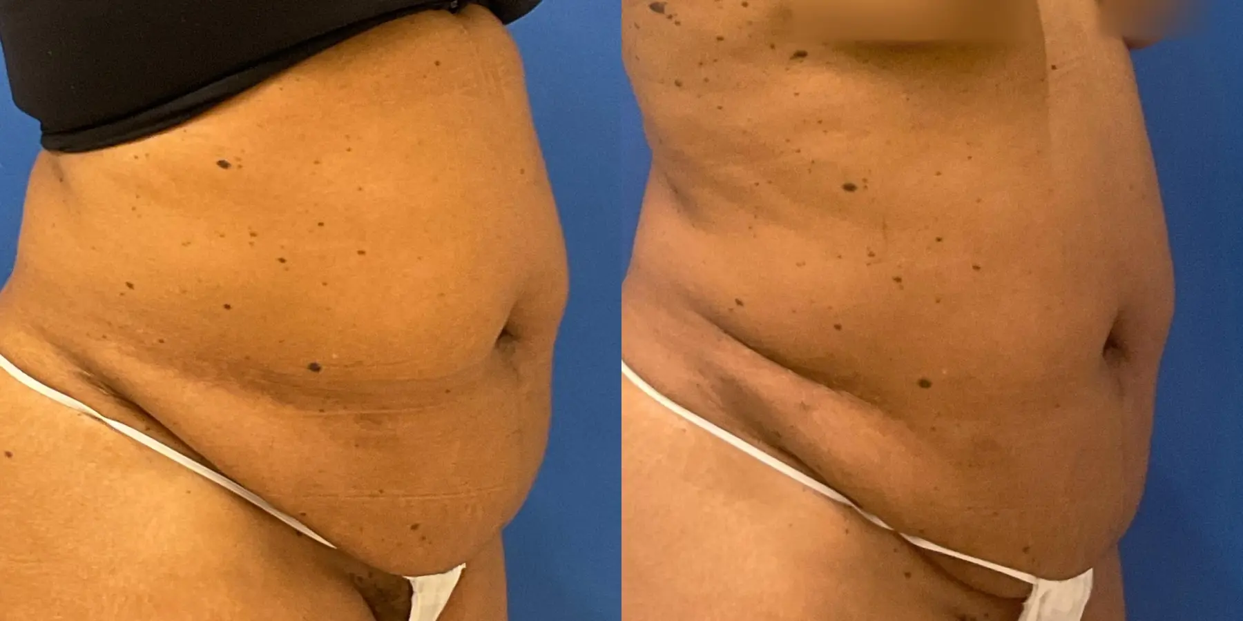 Liposuction: Patient 6 - Before and After 3