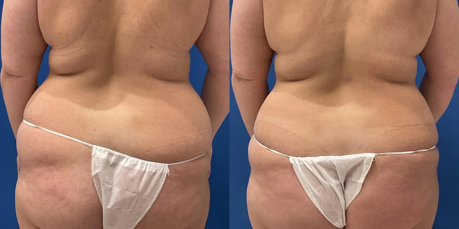 Before and after a liposuction. - Before and After 6