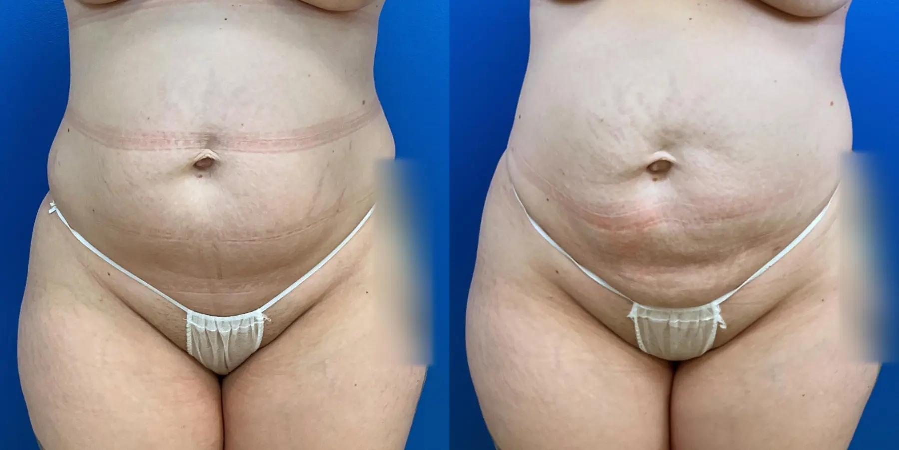 Liposuction: Patient 11 - Before and After  