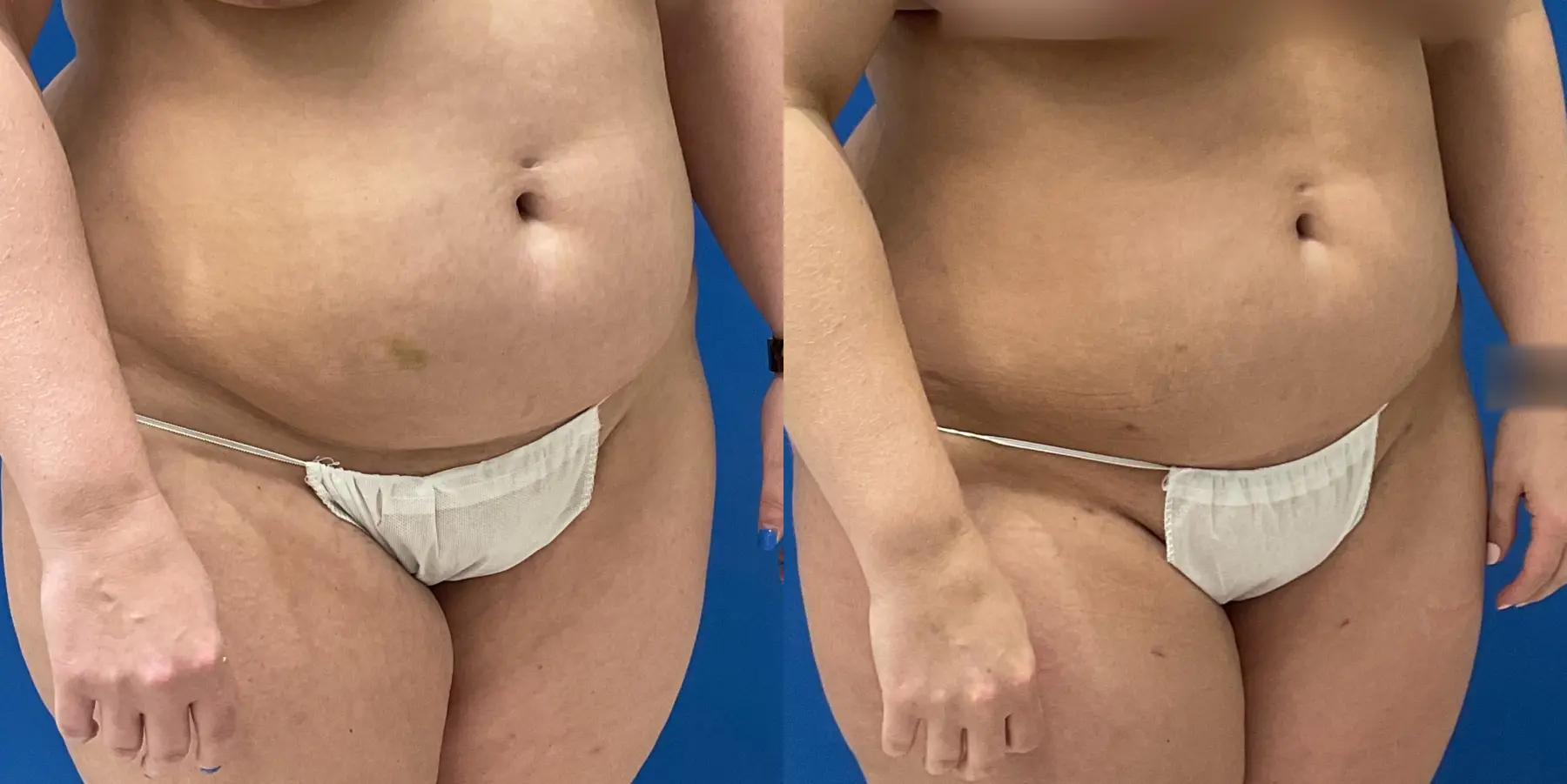 Before and after a liposuction. - Before and After 3