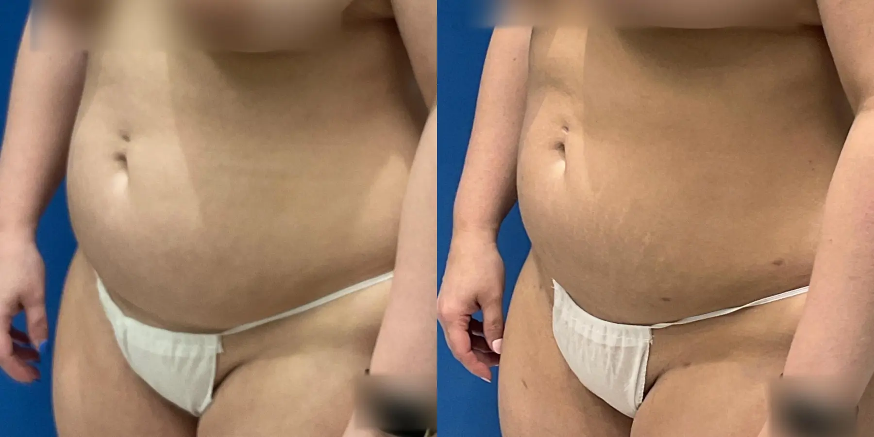 Before and after a liposuction. - Before and After 2