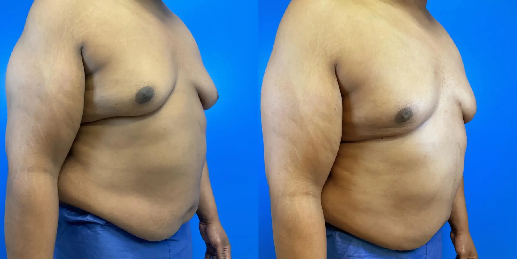 Before and after a liposuction. - Before and After 3