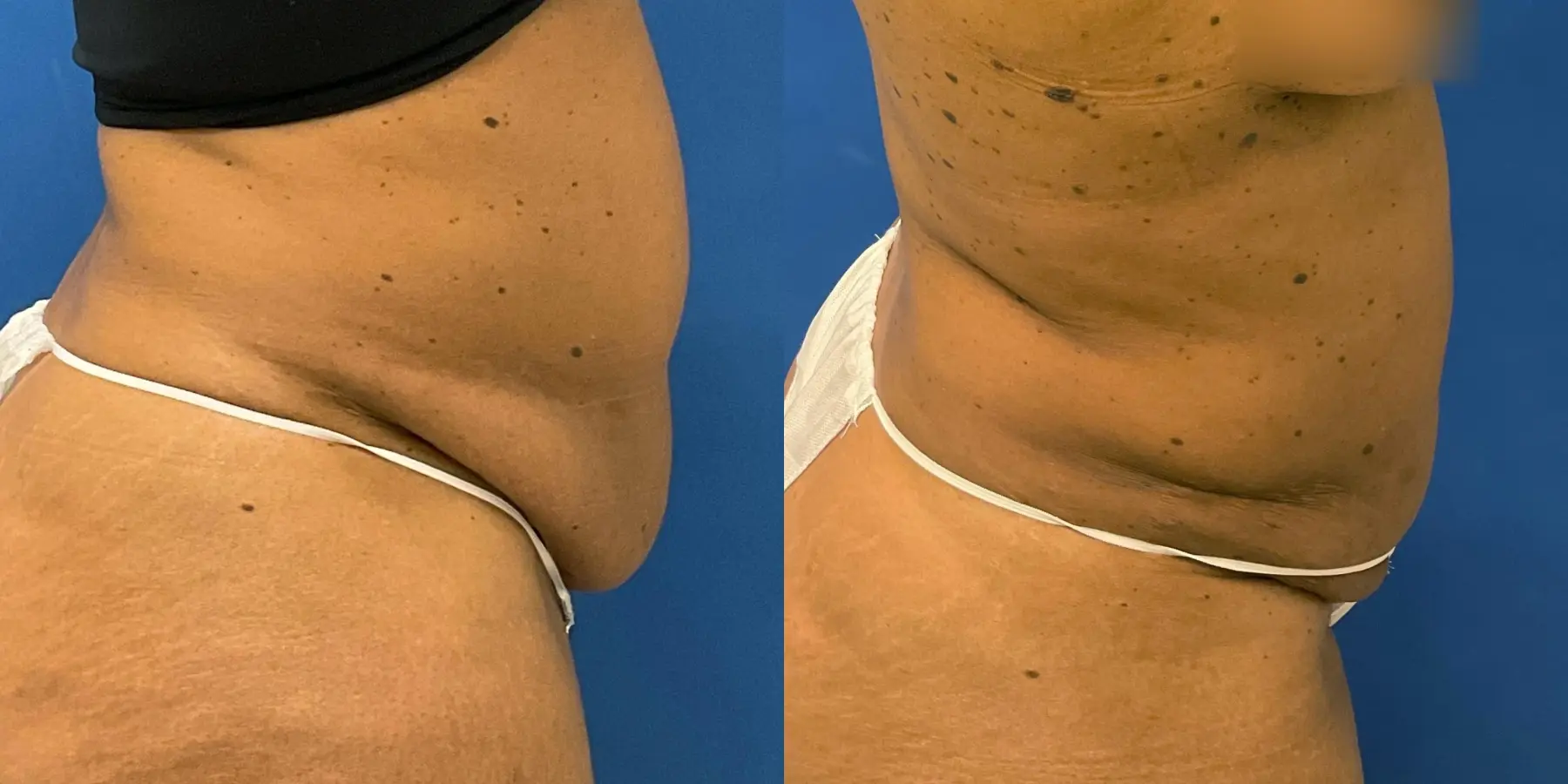 Liposuction: Patient 6 - Before and After 5